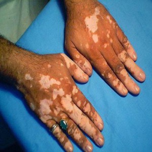 Vitiligo treatment in Gurgaon